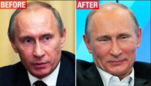 プーチン大統領の浮腫